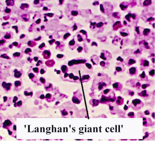 File:Langhans giant cell.jpg