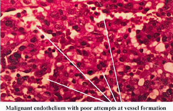 File:Haemangioscarcoma histo.jpg