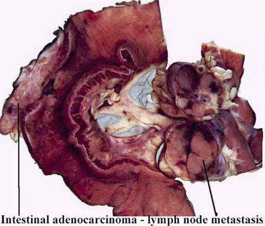 File:Intestinal adenocarcinoma lymphatic spread.jpg