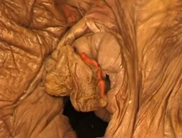 Isolated porcine uterus dissection.jpg