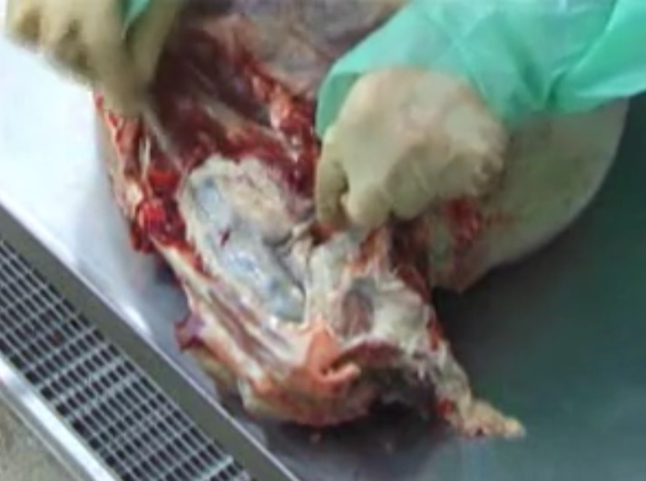Sacro-tuberous (sacro-sciatic) ligament dissection.jpg