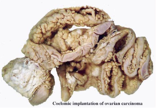 File:Coelomic implantation ovarian carcinoma.jpg