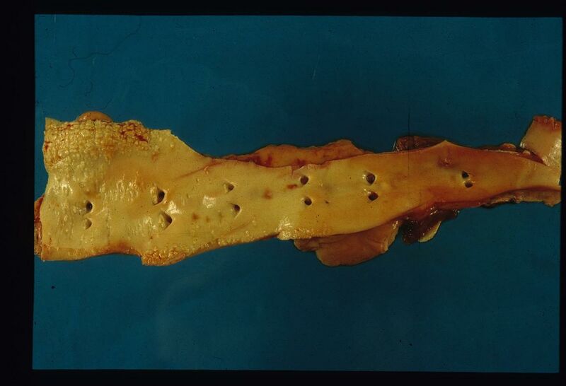 File:Aortic mineralisation.jpg