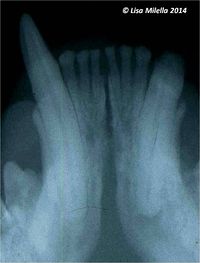 Endodontic disease radiograph 2.jpg