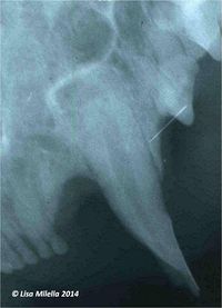 Endodontic disease radiograph 1.jpg