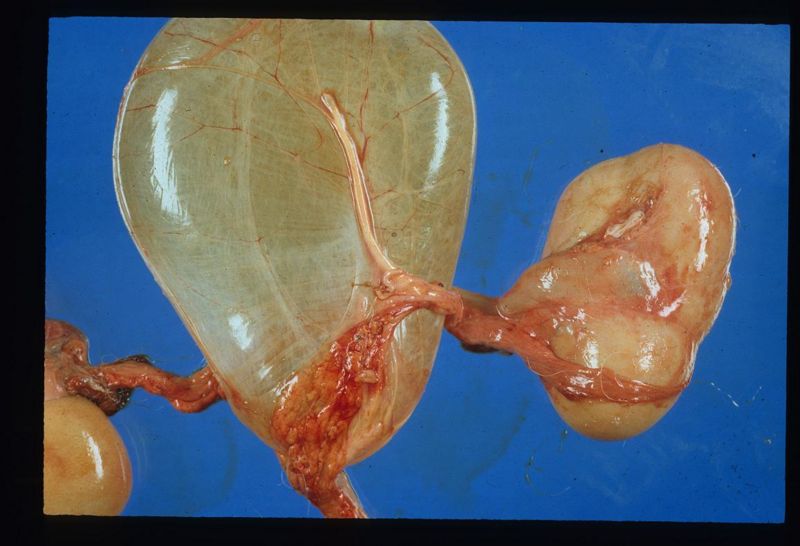 File:Hydronephrosis.jpg