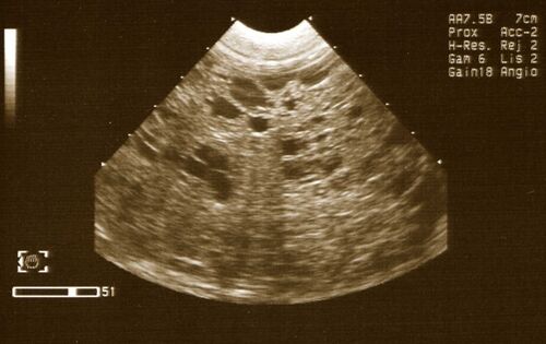 Ultrasound Image (Courtesy of A. Antonczyk)