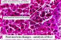 Autolysis of liver.jpg